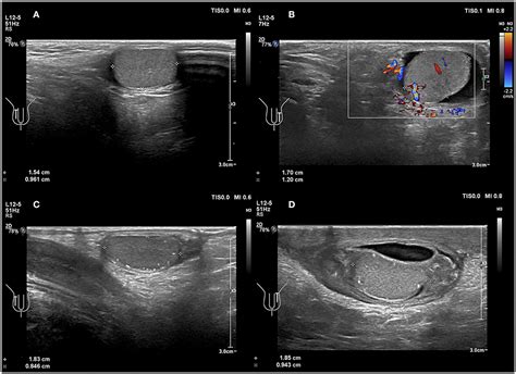 ultrasound testicular torsion test